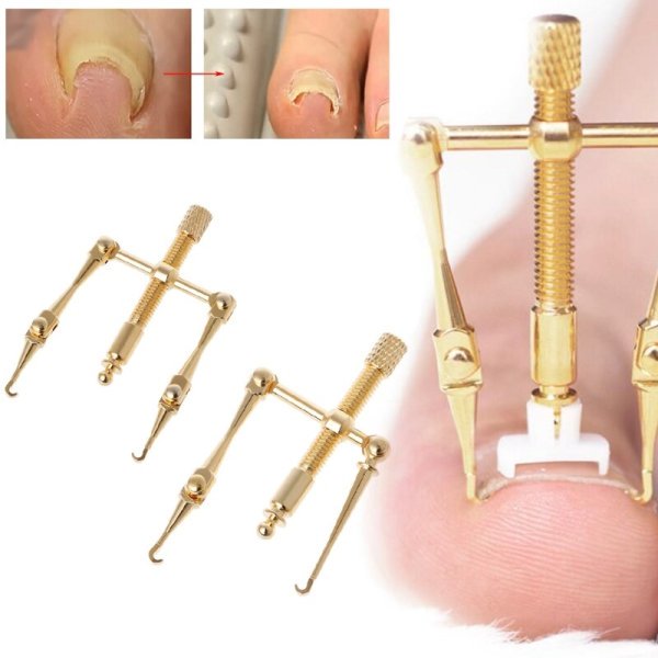 Устройство для восстановления вросшего ногтя Makizume Robo Ingrown Toenail Fixer.